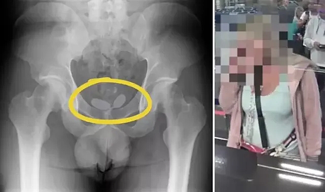 Röntgende ortaya çıktı! Uyuşturucuyu prezervatiflerin içine koyup cinsel organına gizlemiş