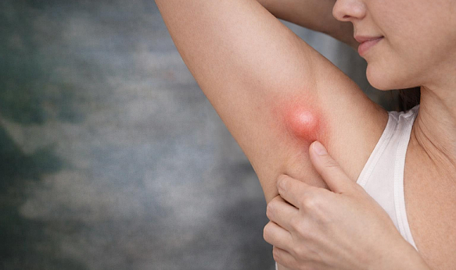 Koltuk Altındaki Şişlik Her Zaman Masum Değil: Ektopik Meme Dokusu Uyarısı